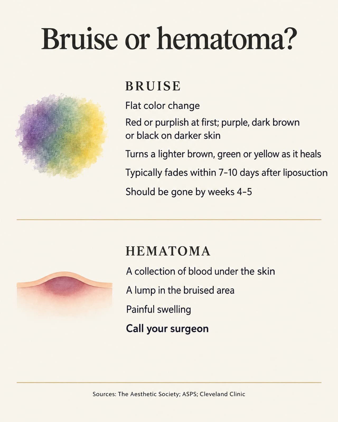 Bruise or hematoma comparison card. Bruise: flat color change; red or purplish at first; purple, dark brown or black on darker skin; turns lighter brown, green or yellow as it heals; typically fades within 7–10 days after liposuction; should be gone by weeks 4–5. Hematoma: a collection of blood under the skin; a lump in the bruised area; painful swelling; call your surgeon. Sources: The Aesthetic Society, ASPS and Cleveland Clinic