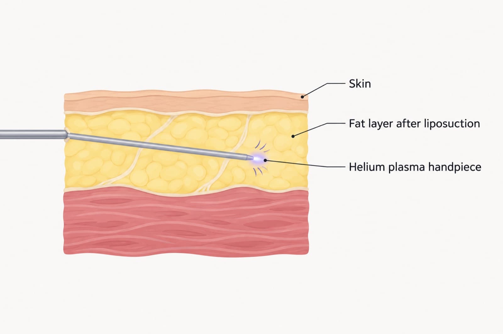 Simple cross-section illustration of the layers under the skin after liposuction, with a thin handpiece passing through the fat layer and a soft glow at its tip, labeled skin, fat layer after liposuction and helium plasma handpiece