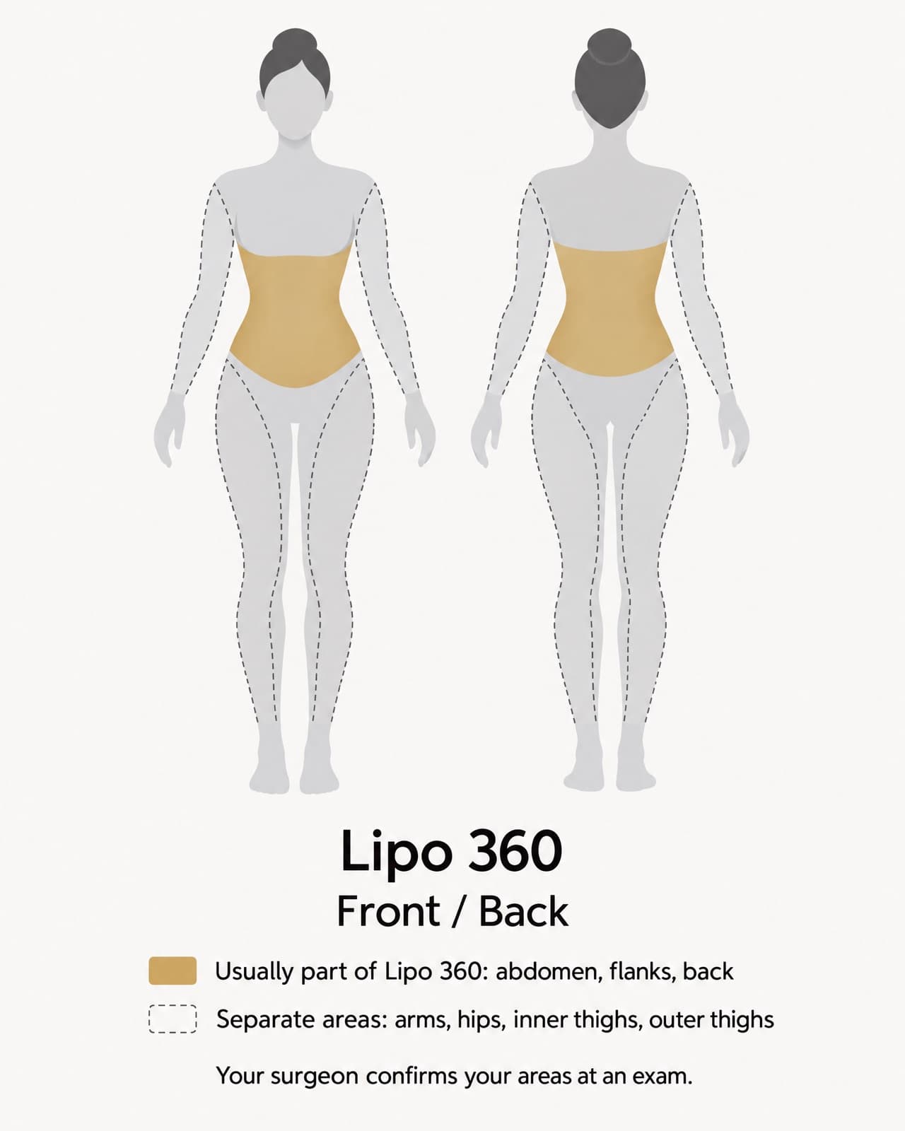 Stylised front and back body map of a figure in a seamless bodysuit: the abdomen, flanks and back shaded gold as the areas Lipo 360 usually covers; the arms, inner and outer thighs and hips outlined in gray as separate areas