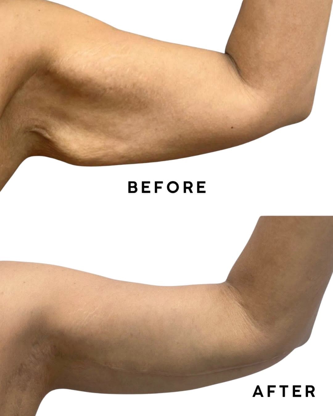 Arm Lift before and after: the patient before surgery and after surgery, Alluring Plastic Surgery, Miami