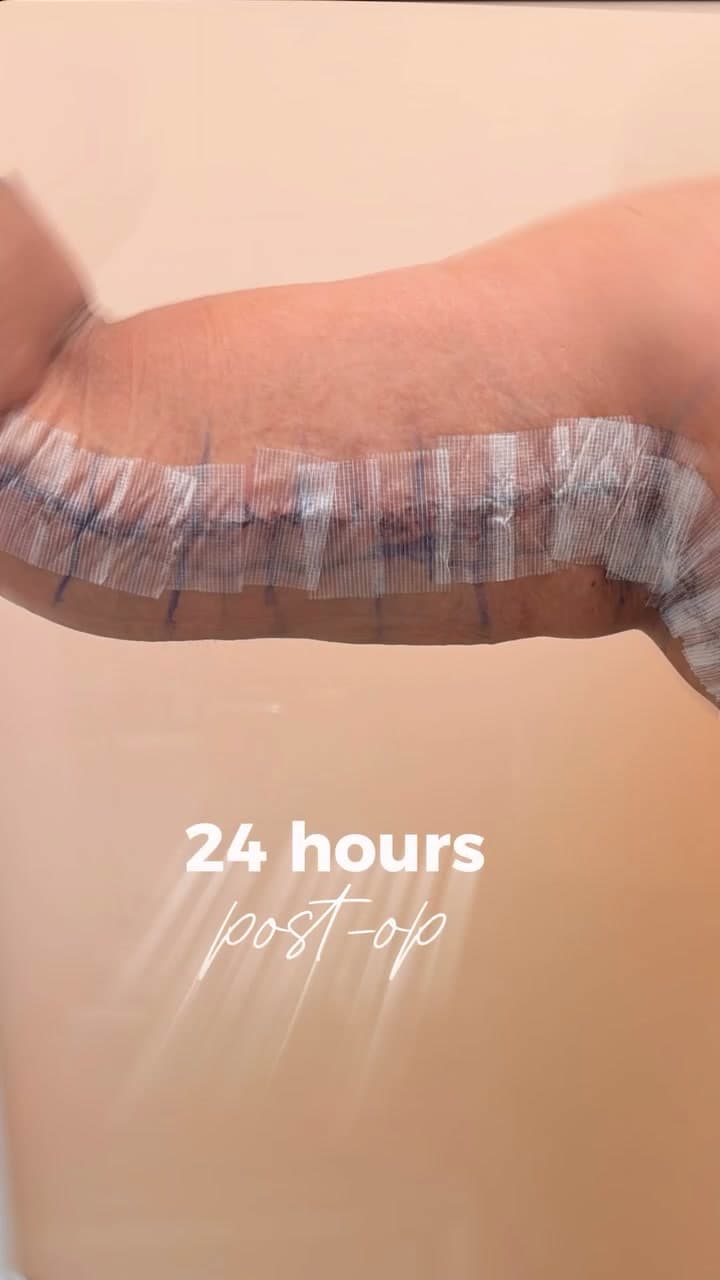 Arm Lift before and after 24 hours post-op: the patient before surgery and after surgery, Alluring Plastic Surgery, Miami