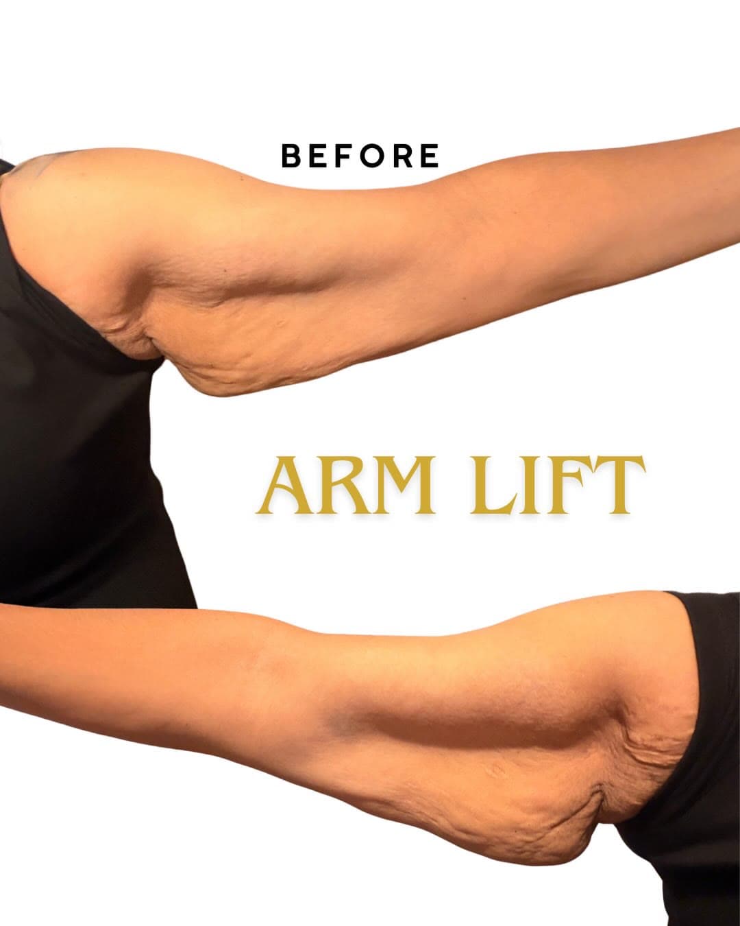 Arm Lift before and after 24 hours post-op: the patient before surgery and after surgery, Alluring Plastic Surgery, Miami