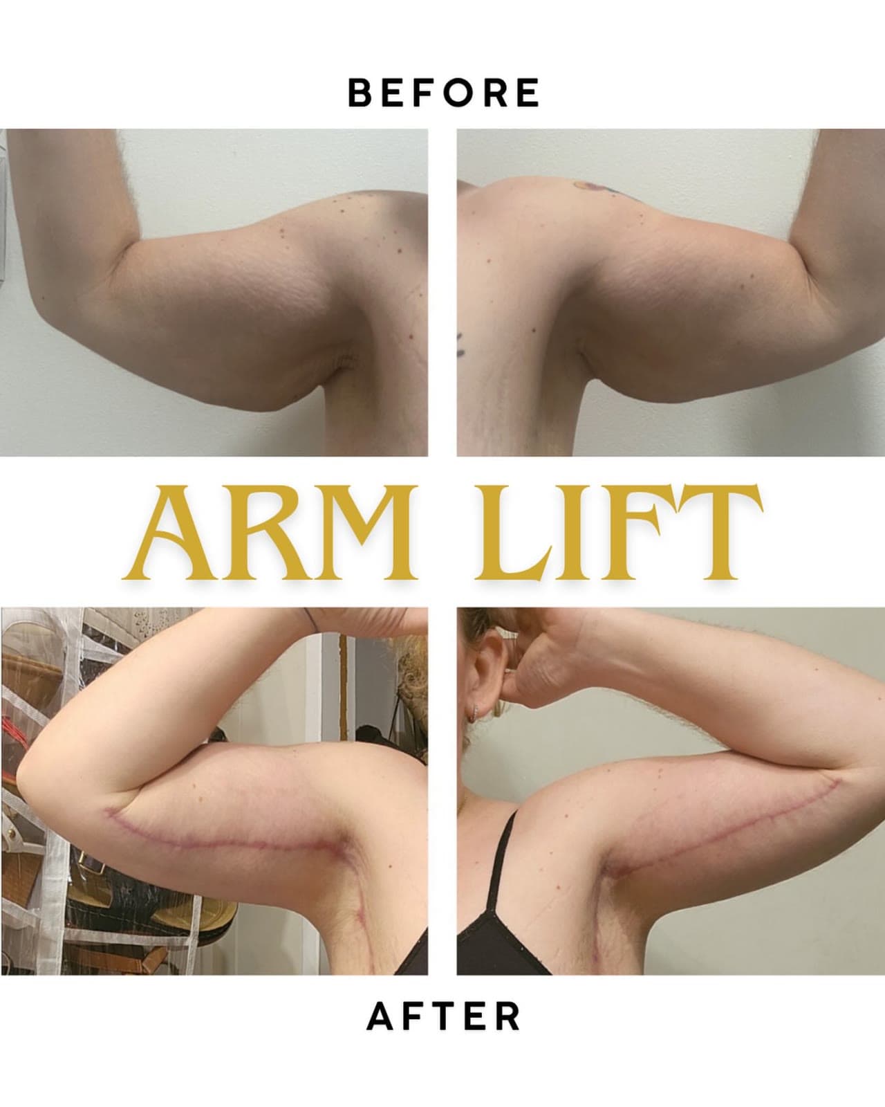 Arm Lift before and after: the patient before surgery and after surgery, Alluring Plastic Surgery, Miami