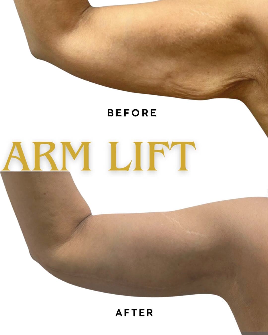 Arm Lift before and after: the patient before surgery and after surgery, Alluring Plastic Surgery, Miami