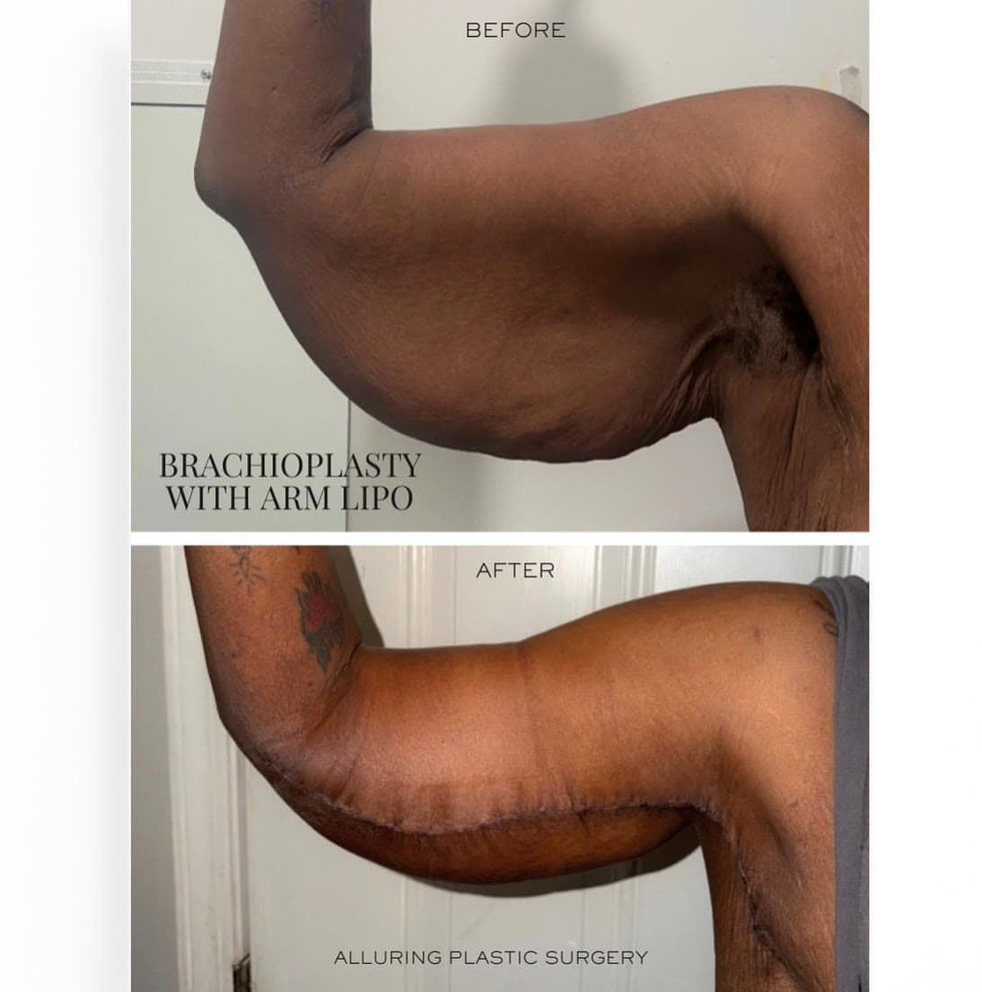 Arm Lift with Arm Liposuction before and after: the patient before surgery and after surgery, Alluring Plastic Surgery, Miami