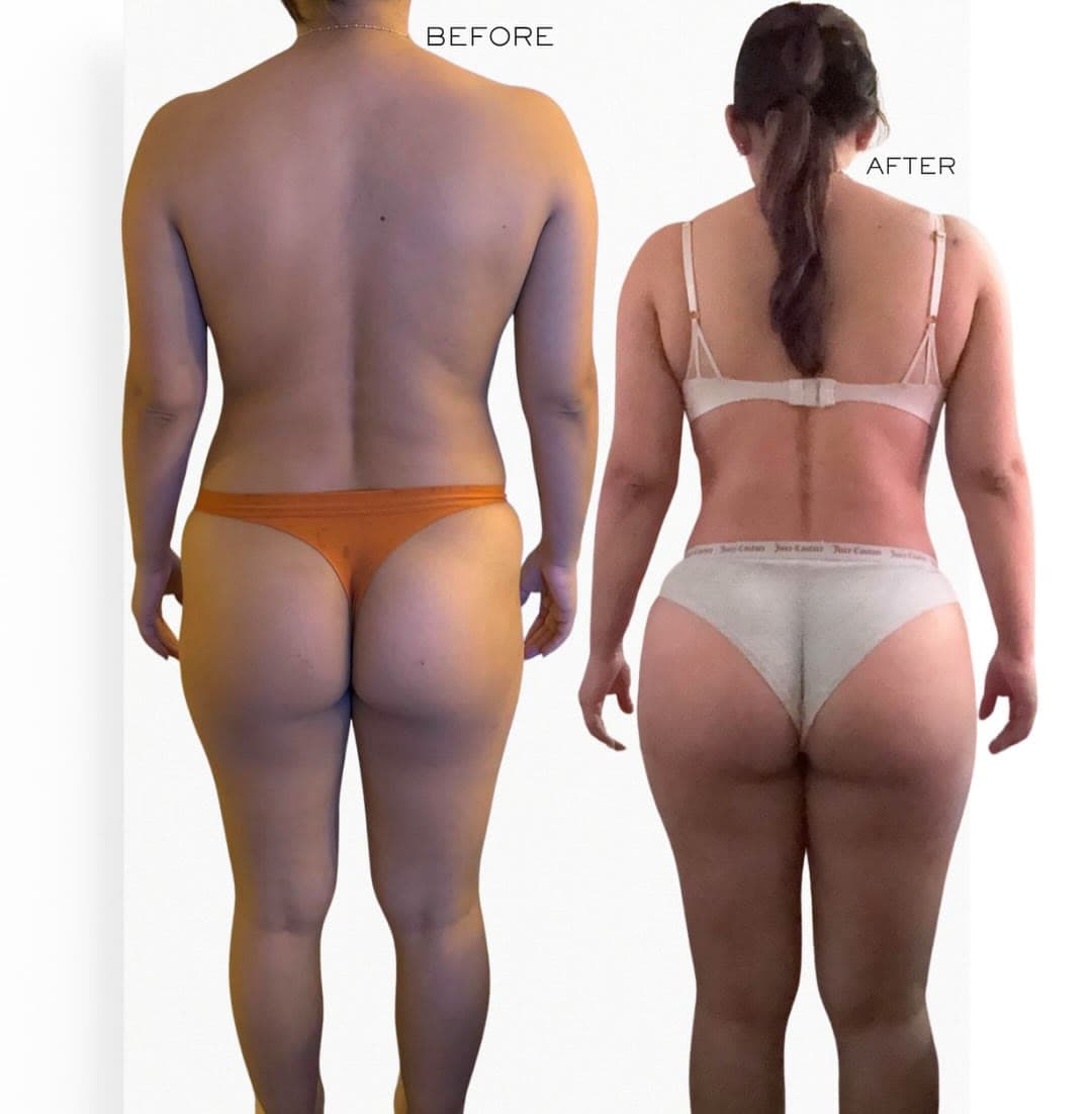 BBL before and after 1 year post-op: the patient before surgery and after surgery, Alluring Plastic Surgery, Miami