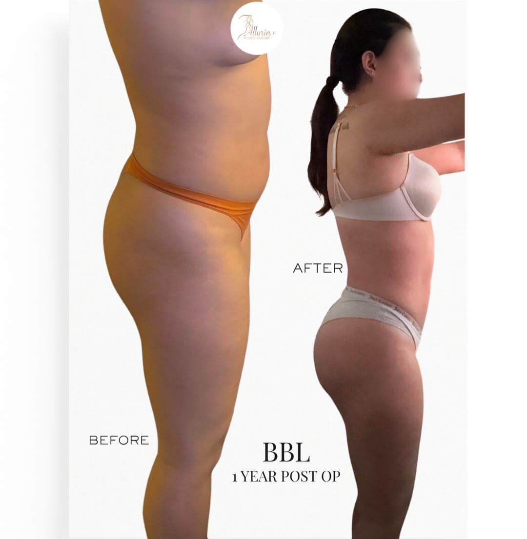 BBL before and after 1 year post-op: the patient before surgery and after surgery, Alluring Plastic Surgery, Miami