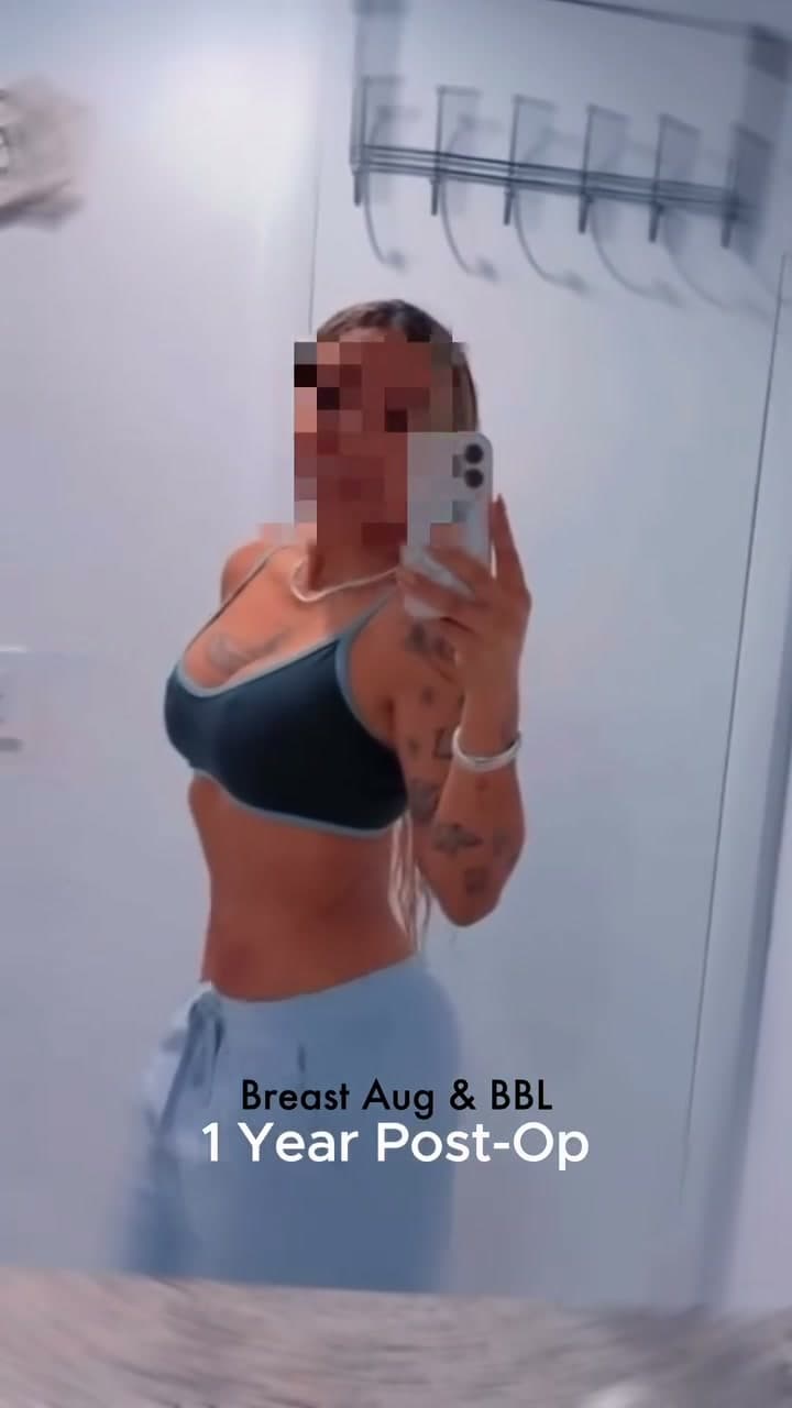 Breast Augmentation + BBL before and after 1 year post-op: the patient before surgery and after surgery, Alluring Plastic Surgery, Miami