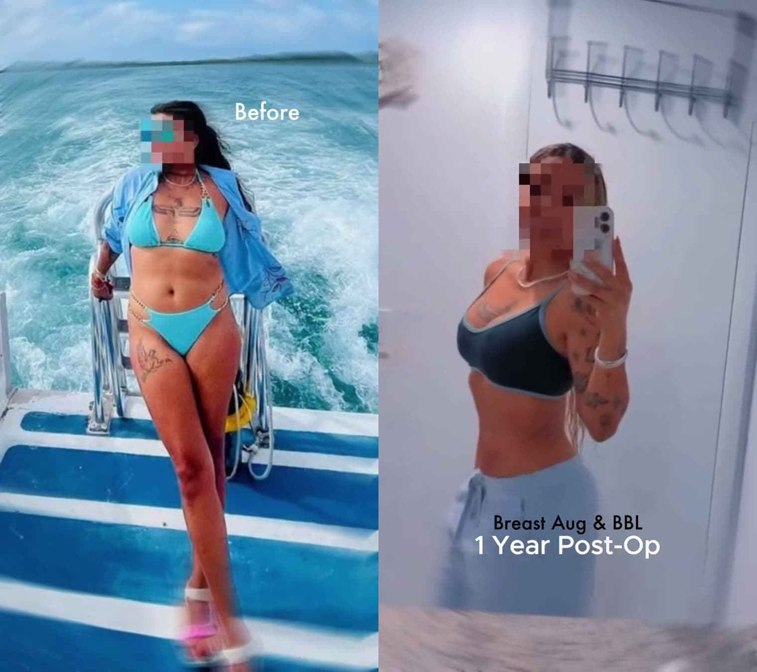 Breast Augmentation + BBL before and after 1 year post-op: the patient before surgery and after surgery, Alluring Plastic Surgery, Miami