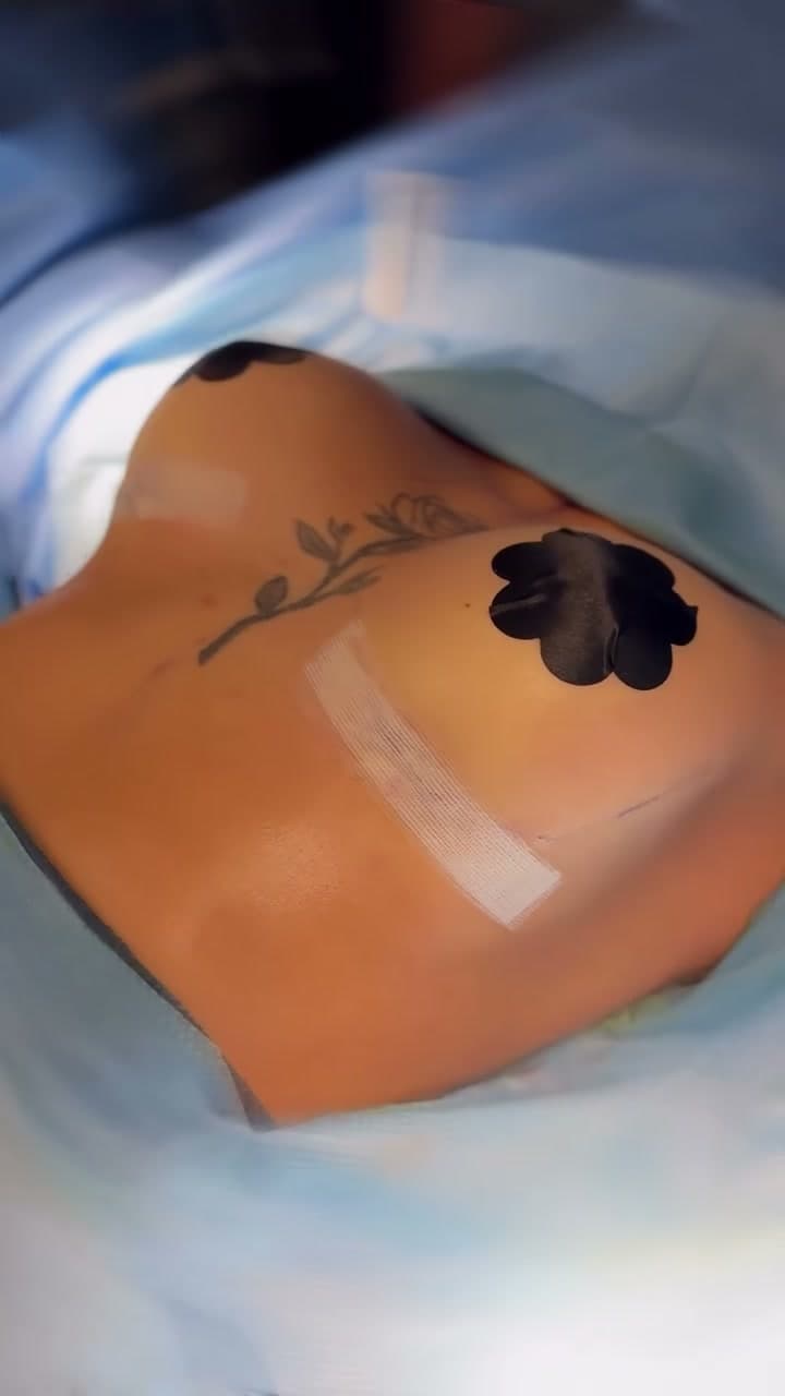 Breast Augmentation before and after: the patient before surgery and right after surgery in the operating room, Alluring Plastic Surgery, Miami