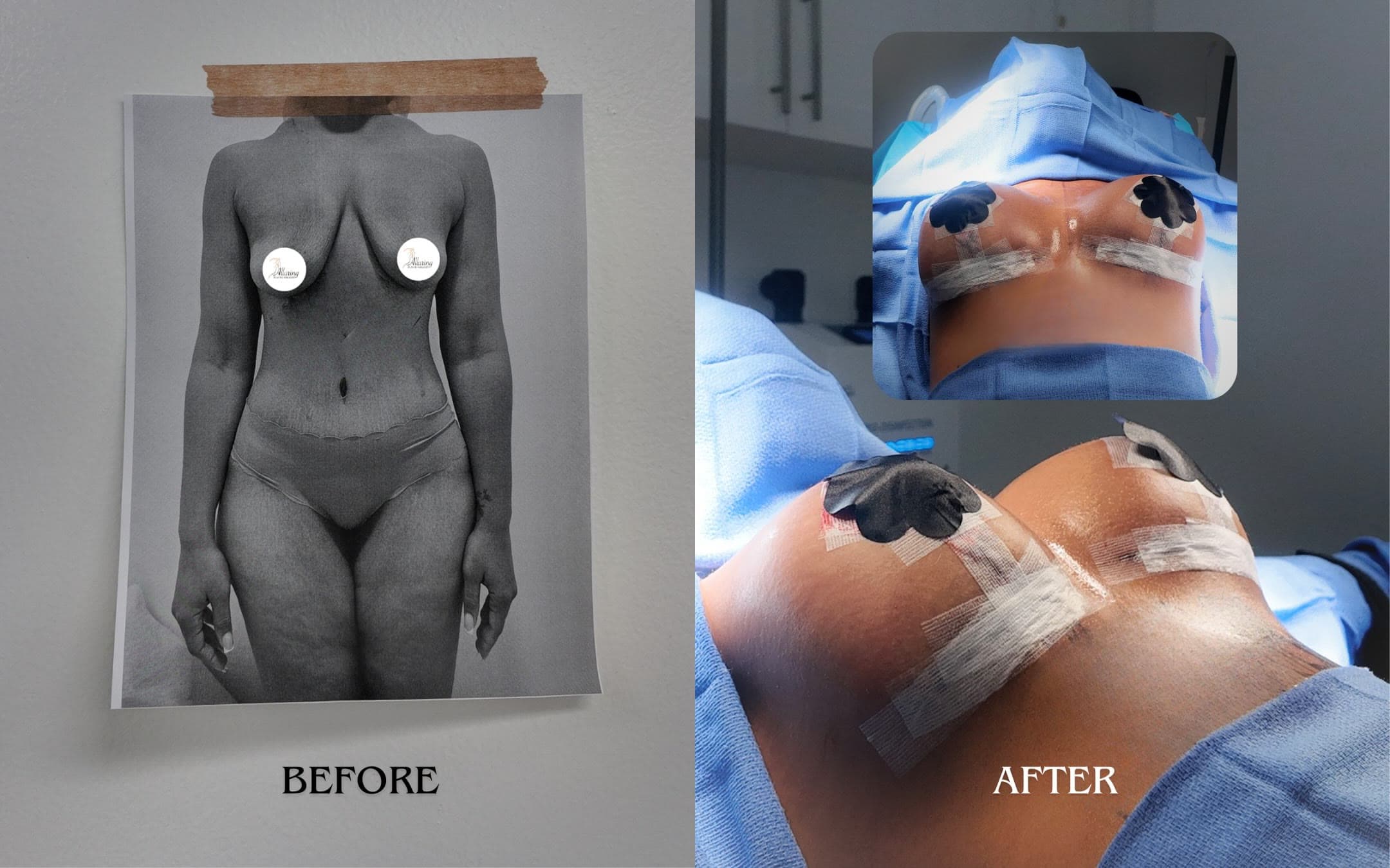 Breast Lift with Implants before and after: the patient before surgery and right after surgery in the operating room, Alluring Plastic Surgery, Miami