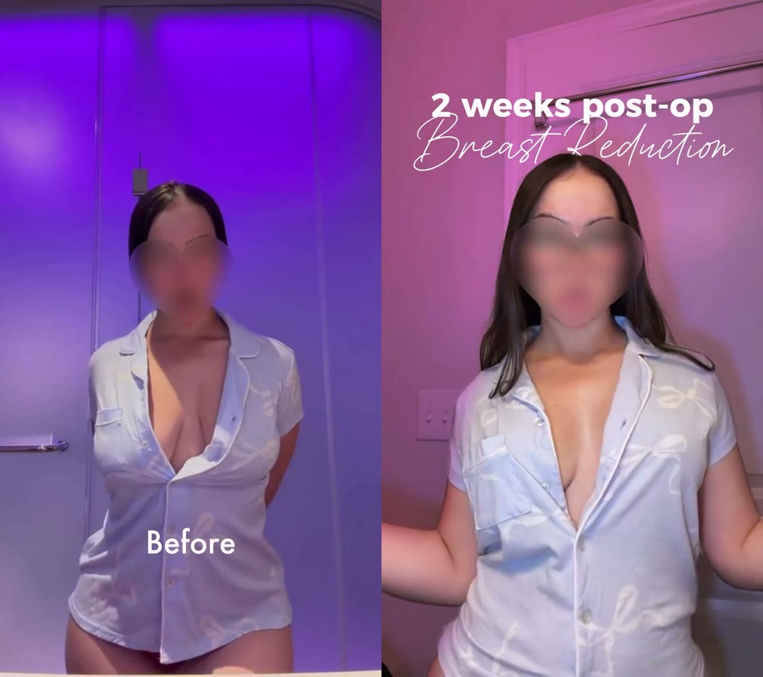 Breast Reduction before and after 2 weeks post-op: the patient before surgery and after surgery, Alluring Plastic Surgery, Miami