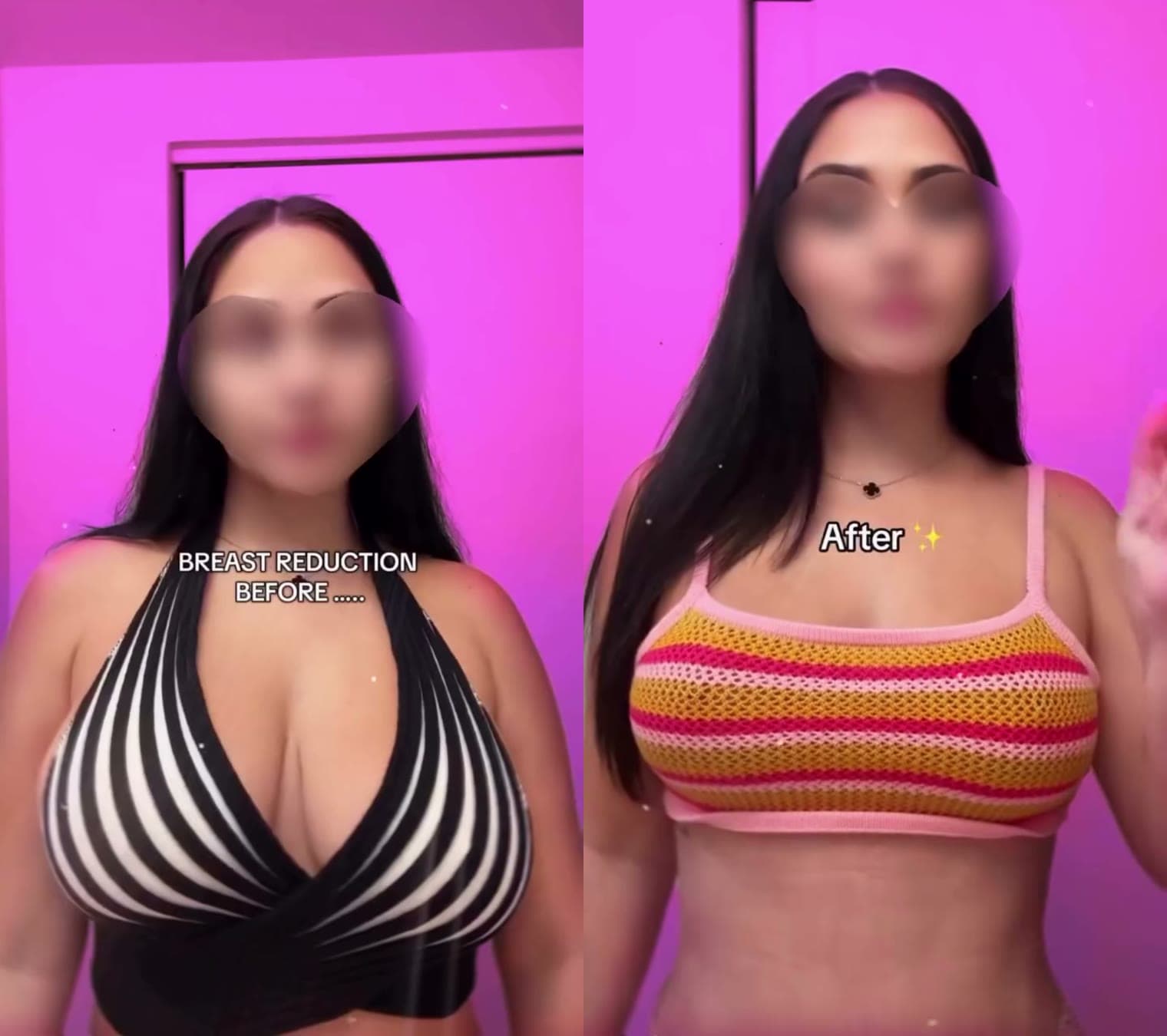 Breast Reduction before and after: the patient before surgery and after surgery, Alluring Plastic Surgery, Miami