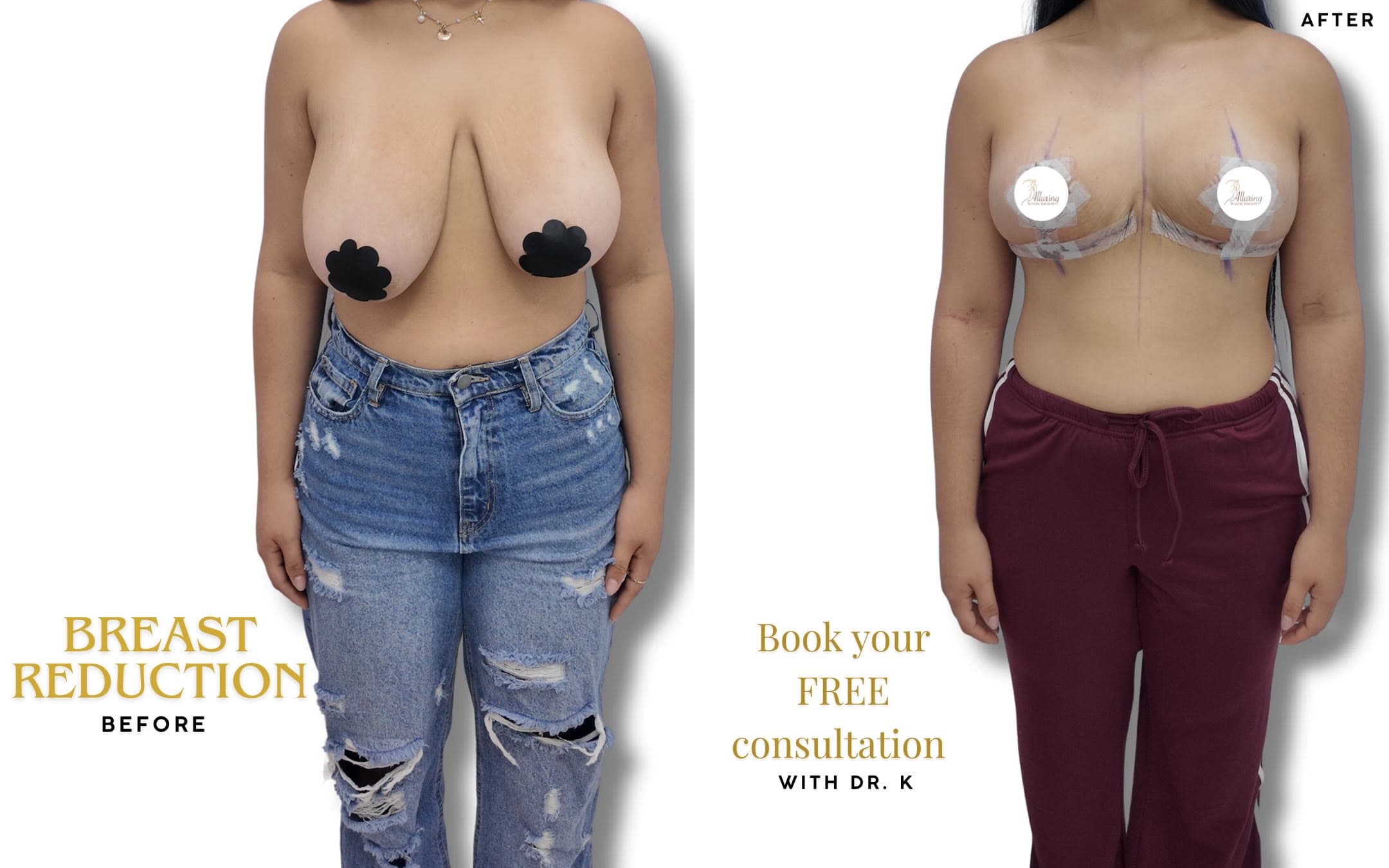 Breast Reduction before and after 24 hours post-op: the patient before surgery and after surgery, Alluring Plastic Surgery, Miami