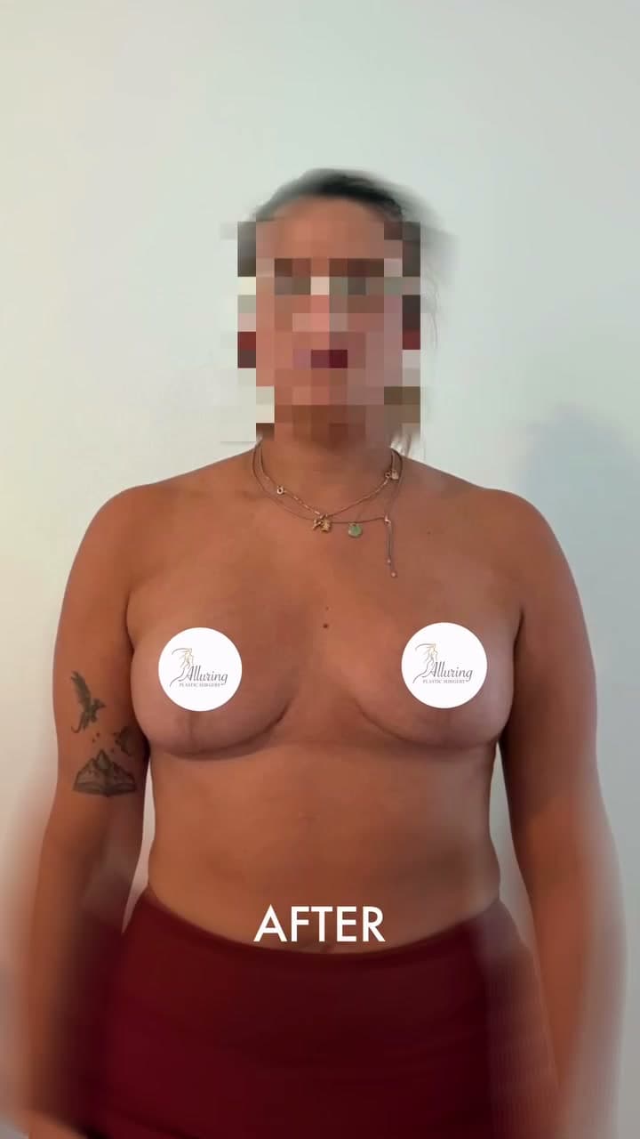Breast Reduction before and after: the patient before surgery and after surgery, Alluring Plastic Surgery, Miami