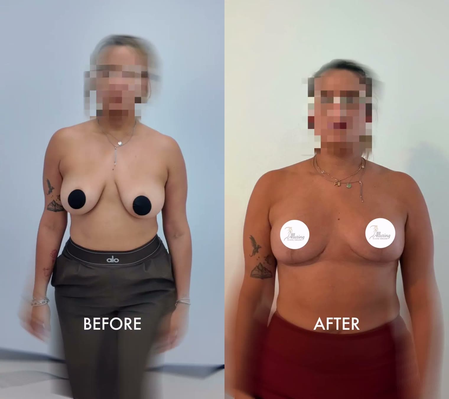 Breast Reduction before and after: the patient before surgery and after surgery, Alluring Plastic Surgery, Miami