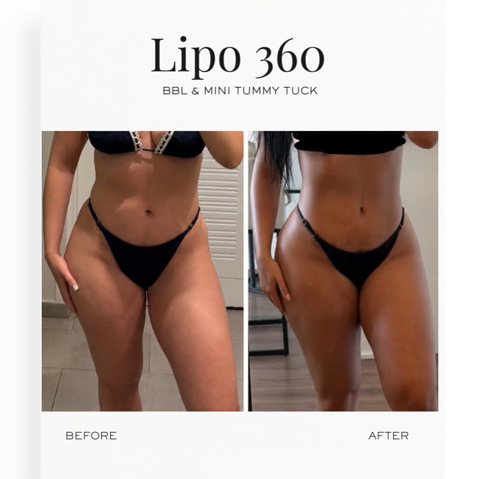 Lipo 360 + BBL + Mini Tummy Tuck before and after: the patient before surgery and after surgery, Alluring Plastic Surgery, Miami