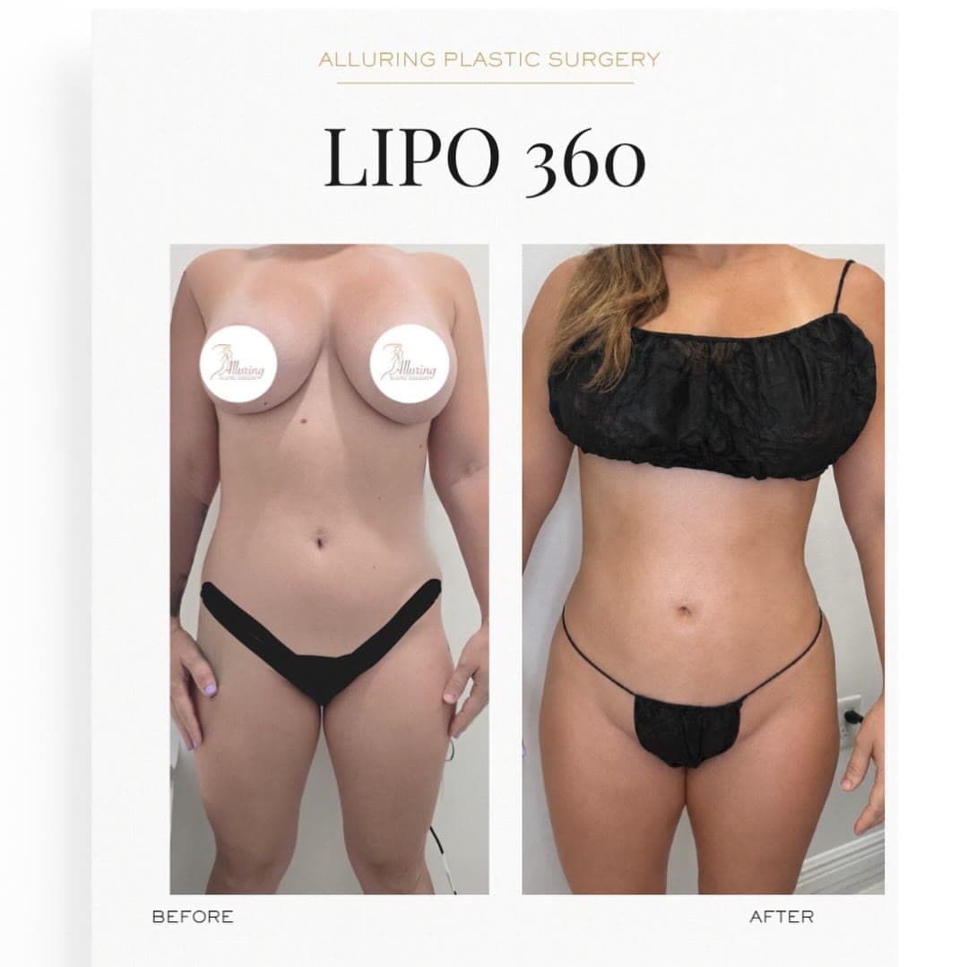 Lipo 360 before and after 24 hours post-op: the patient before surgery and after surgery, Alluring Plastic Surgery, Miami
