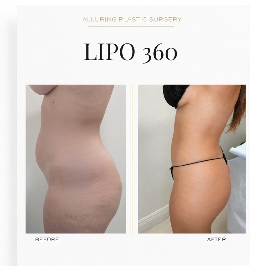 Lipo 360 before and after 24 hours post-op: the patient before surgery and after surgery, Alluring Plastic Surgery, Miami