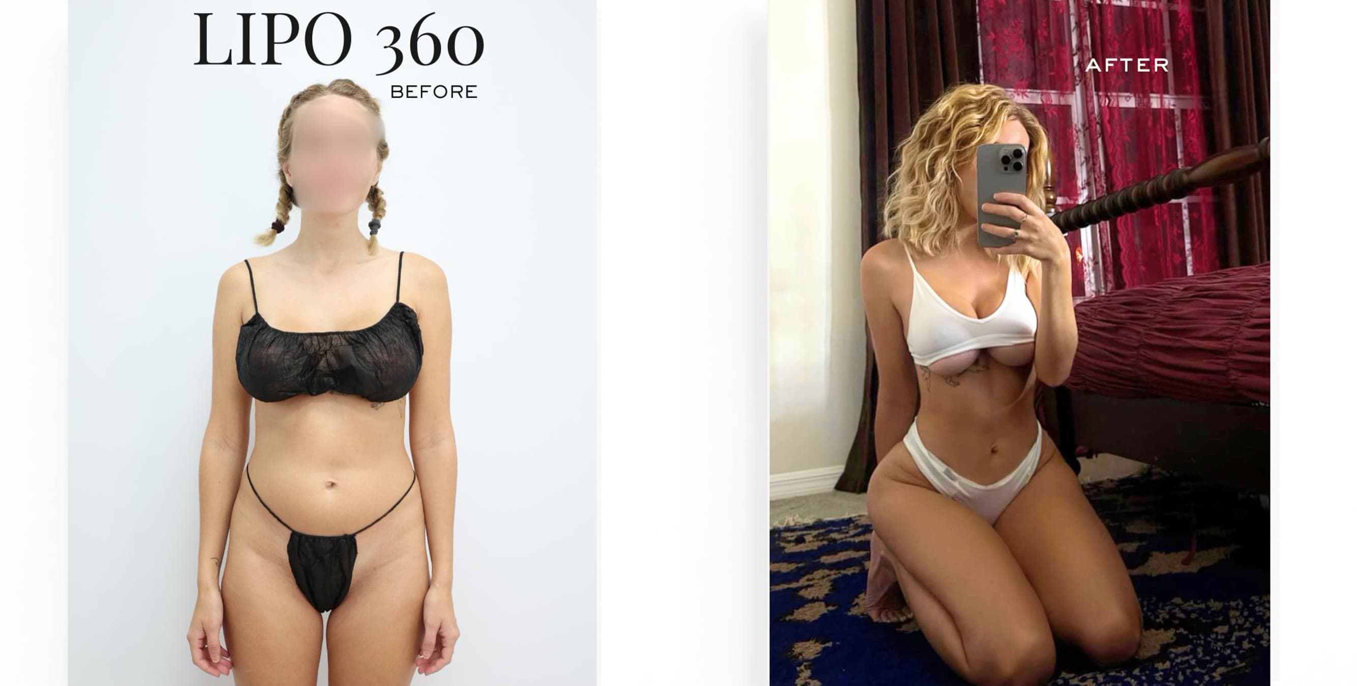 Lipo 360 before and after: the patient before surgery and after surgery, Alluring Plastic Surgery, Miami