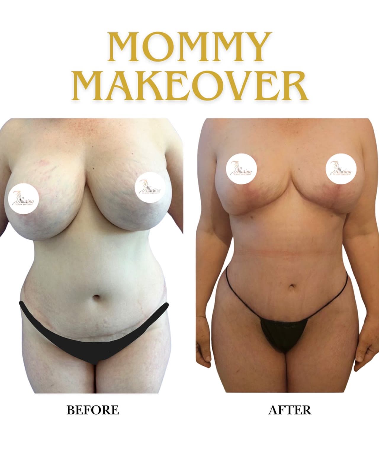 Mommy Makeover before and after: the patient before surgery and after surgery, Alluring Plastic Surgery, Miami