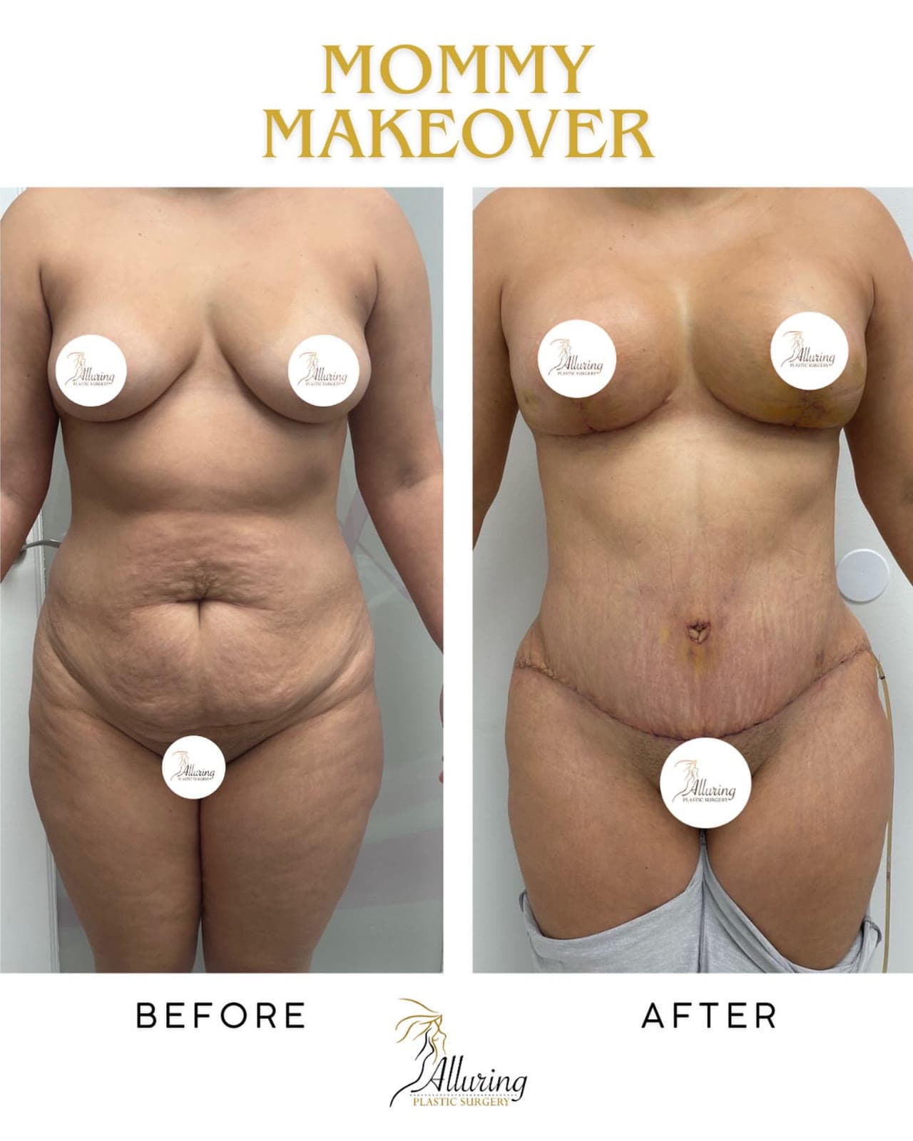 Mommy Makeover before and after: the patient before surgery and after surgery, Alluring Plastic Surgery, Miami