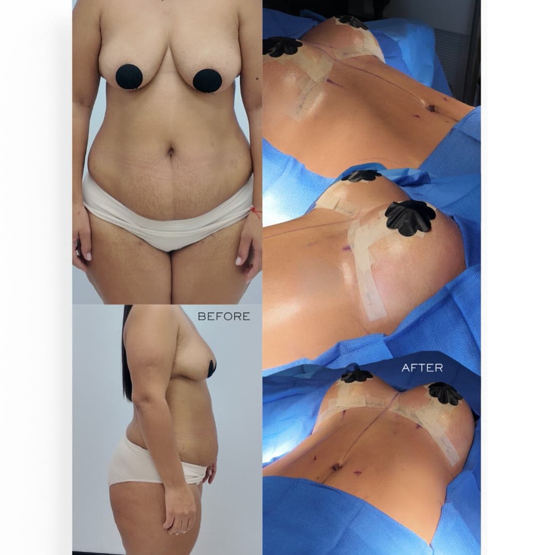 Mommy Makeover before and after: the patient before surgery and right after surgery in the operating room, Alluring Plastic Surgery, Miami