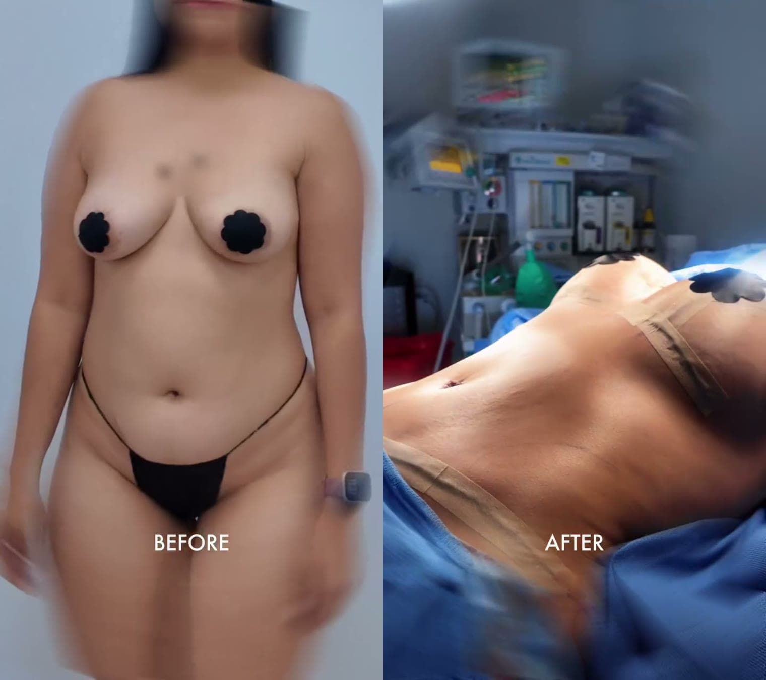 Mommy Makeover before and after: the patient before surgery and right after surgery in the operating room, Alluring Plastic Surgery, Miami