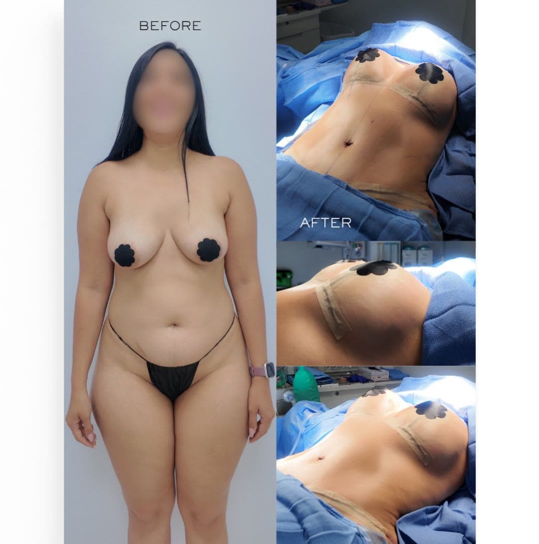 Mommy Makeover before and after: the patient before surgery and right after surgery in the operating room, Alluring Plastic Surgery, Miami