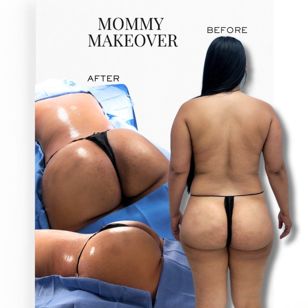 Mommy Makeover before and after: the patient before surgery and after surgery, Alluring Plastic Surgery, Miami