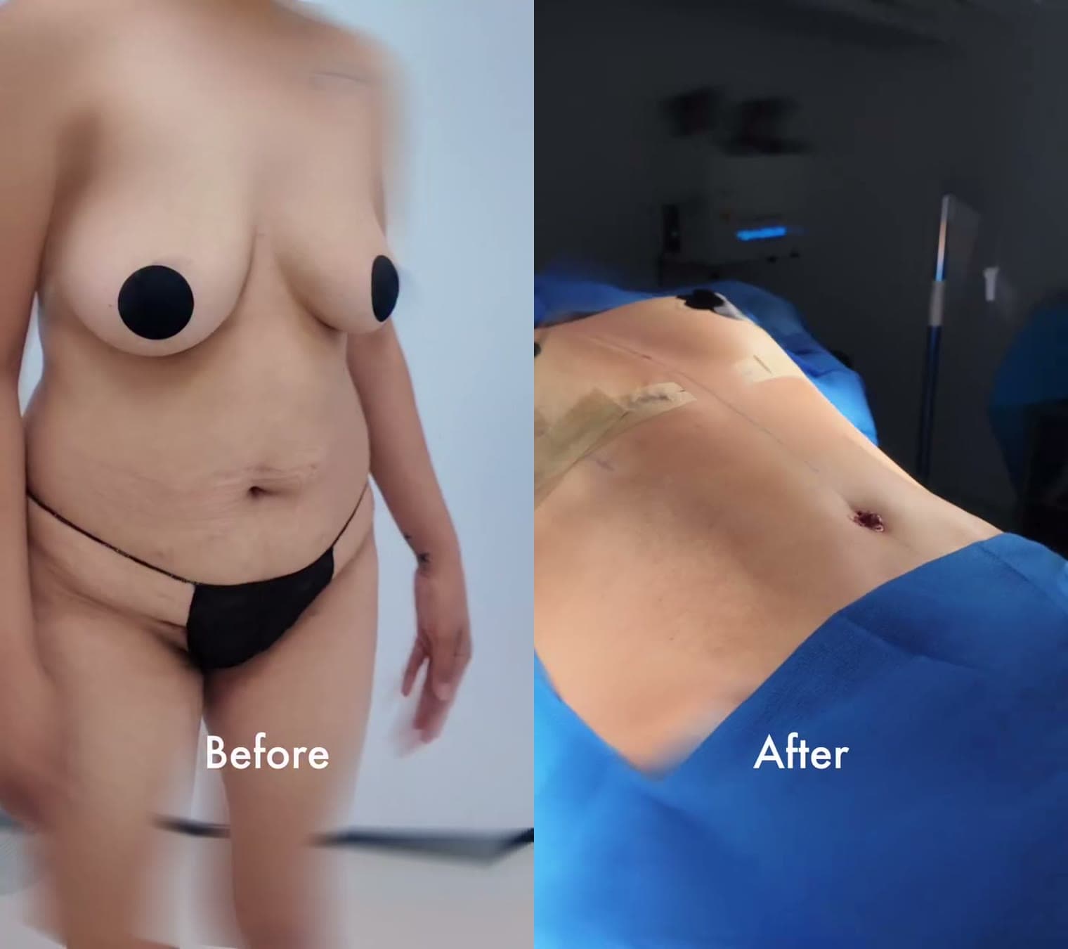 Mommy Makeover before and after: the patient before surgery and right after surgery in the operating room, Alluring Plastic Surgery, Miami