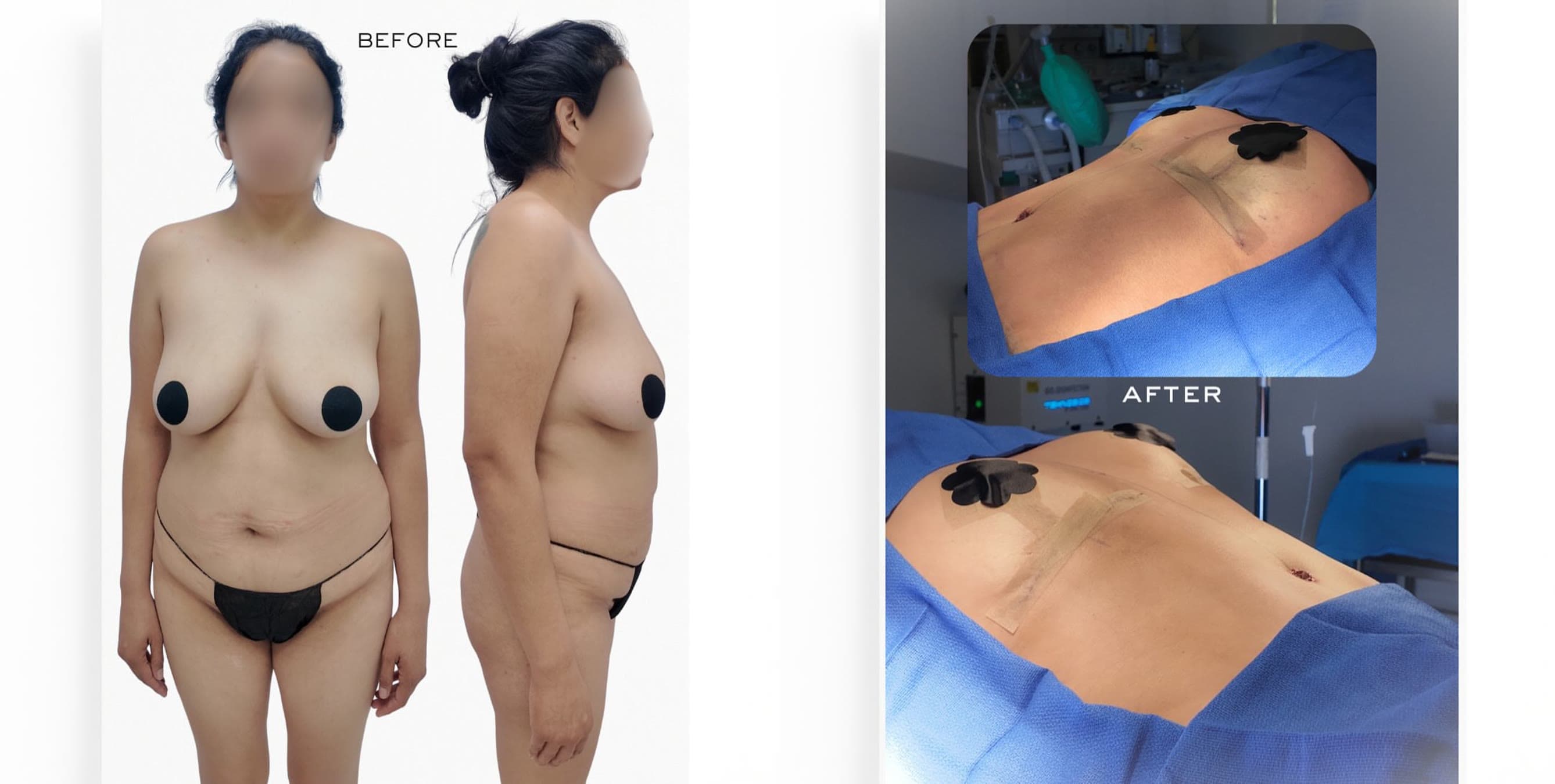 Mommy Makeover before and after: the patient before surgery and right after surgery in the operating room, Alluring Plastic Surgery, Miami