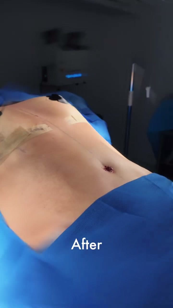 Mommy Makeover before and after: the patient before surgery and right after surgery in the operating room, Alluring Plastic Surgery, Miami