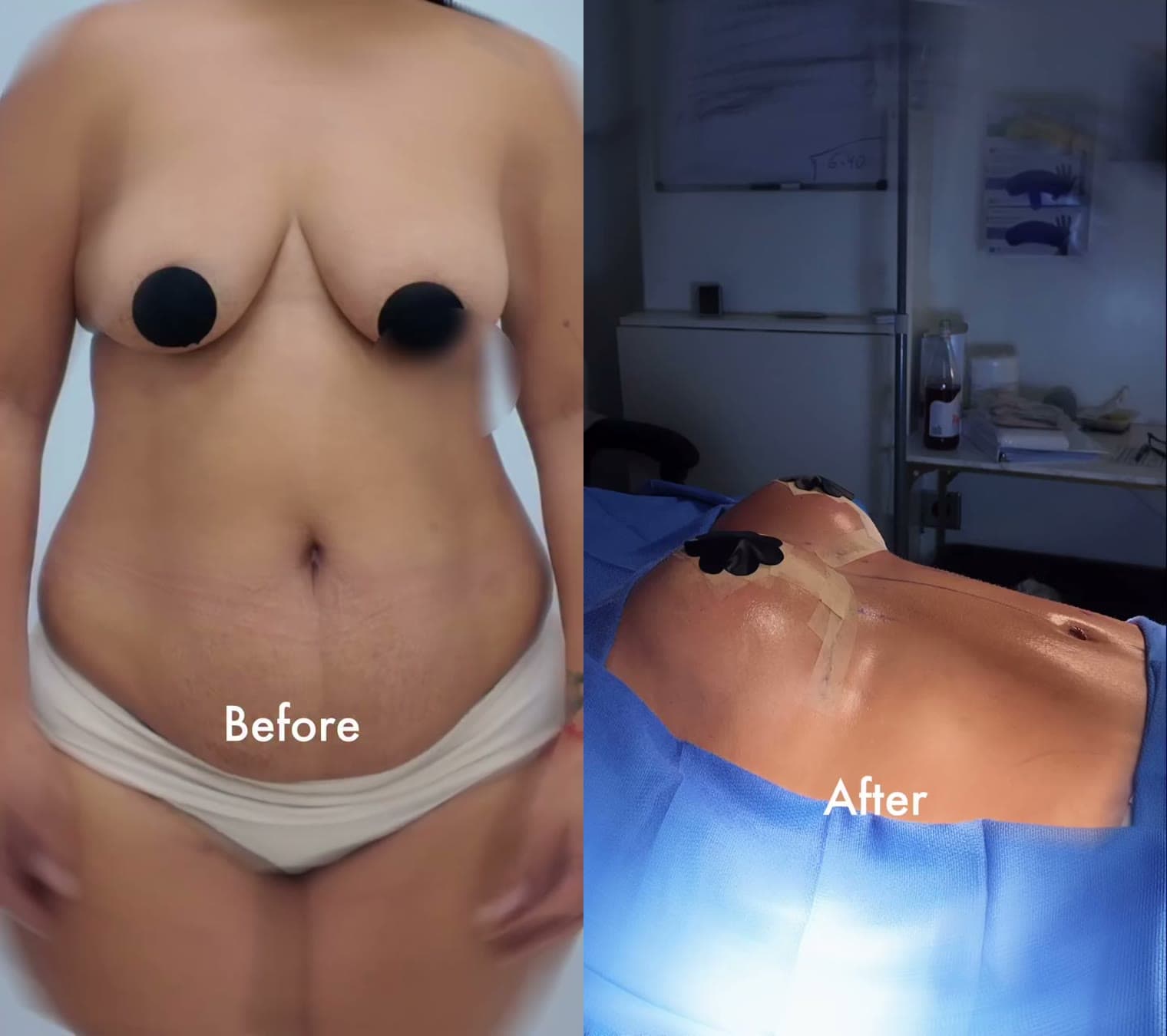 Mommy Makeover before and after: the patient before surgery and right after surgery in the operating room, Alluring Plastic Surgery, Miami