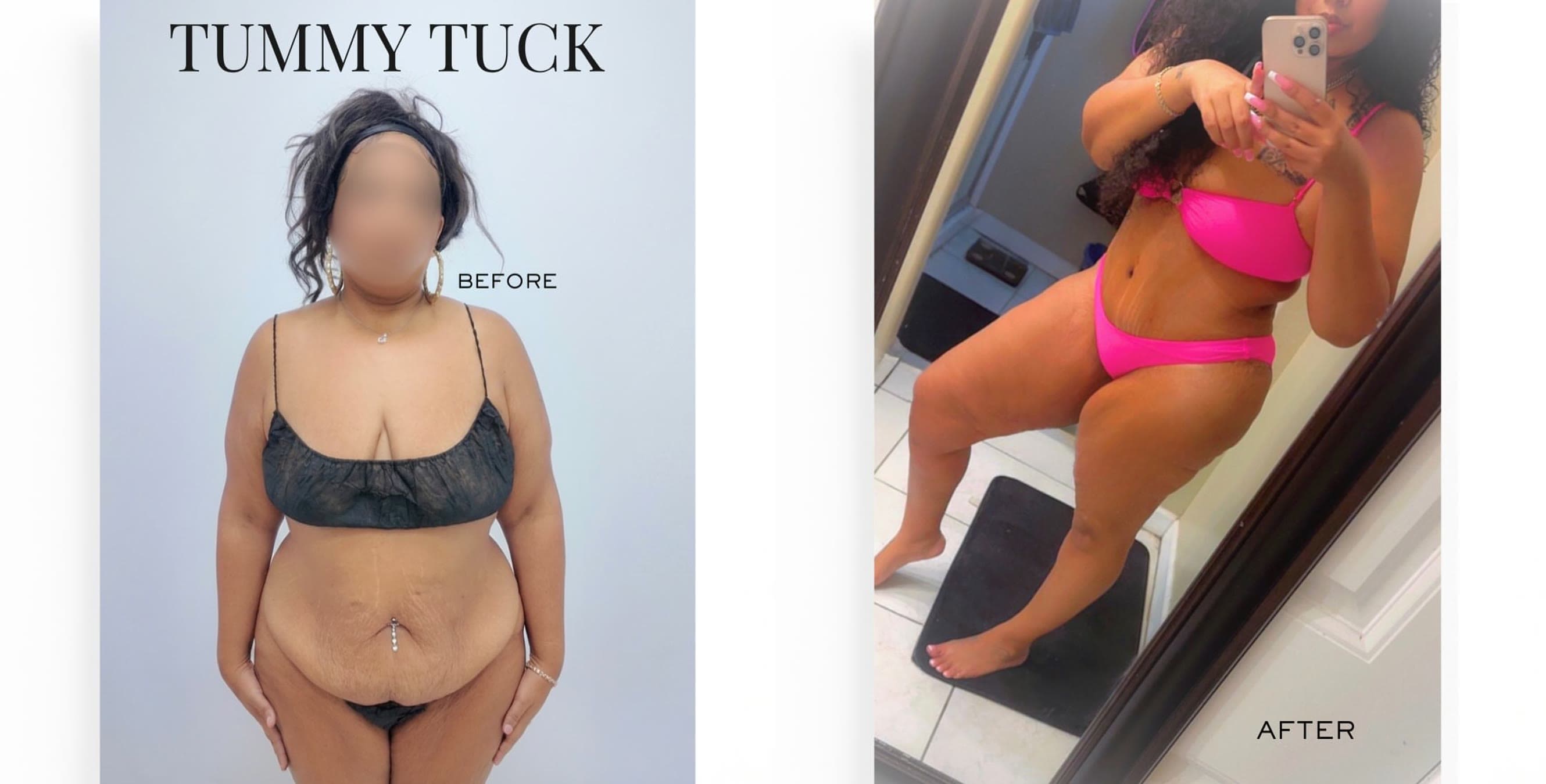 Tummy Tuck before and after: the patient before surgery and after surgery, Alluring Plastic Surgery, Miami