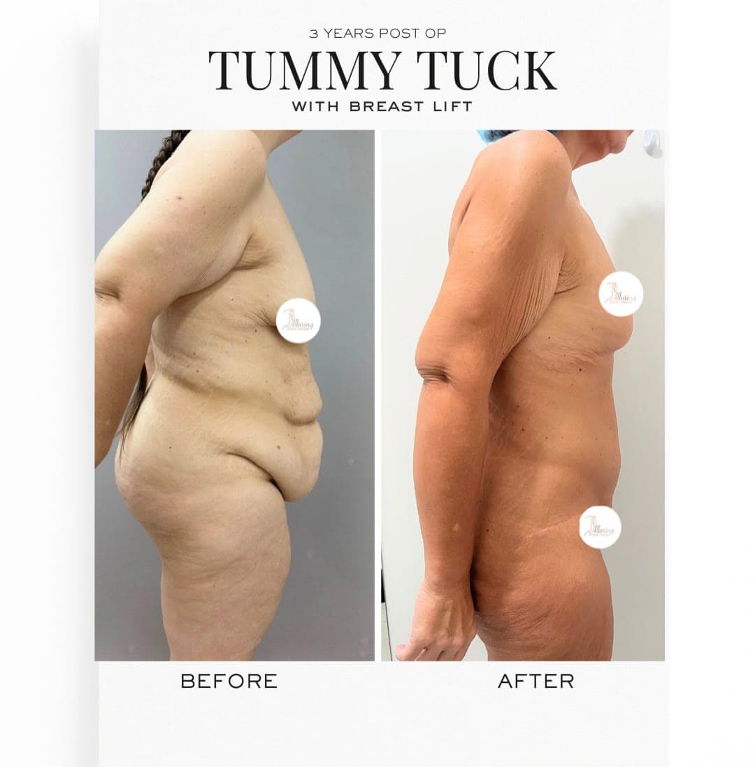 Tummy Tuck + Breast Lift before and after 3 years post-op: the patient before surgery and after surgery, Alluring Plastic Surgery, Miami