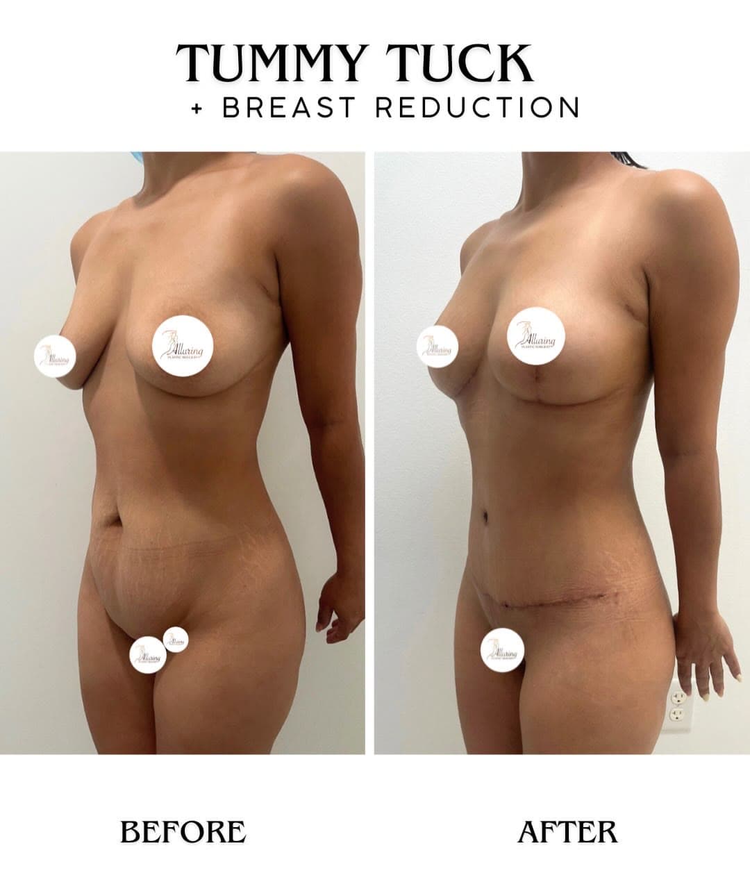 Tummy Tuck + Breast Reduction before and after 1 month post-op: the patient before surgery and after surgery, Alluring Plastic Surgery, Miami
