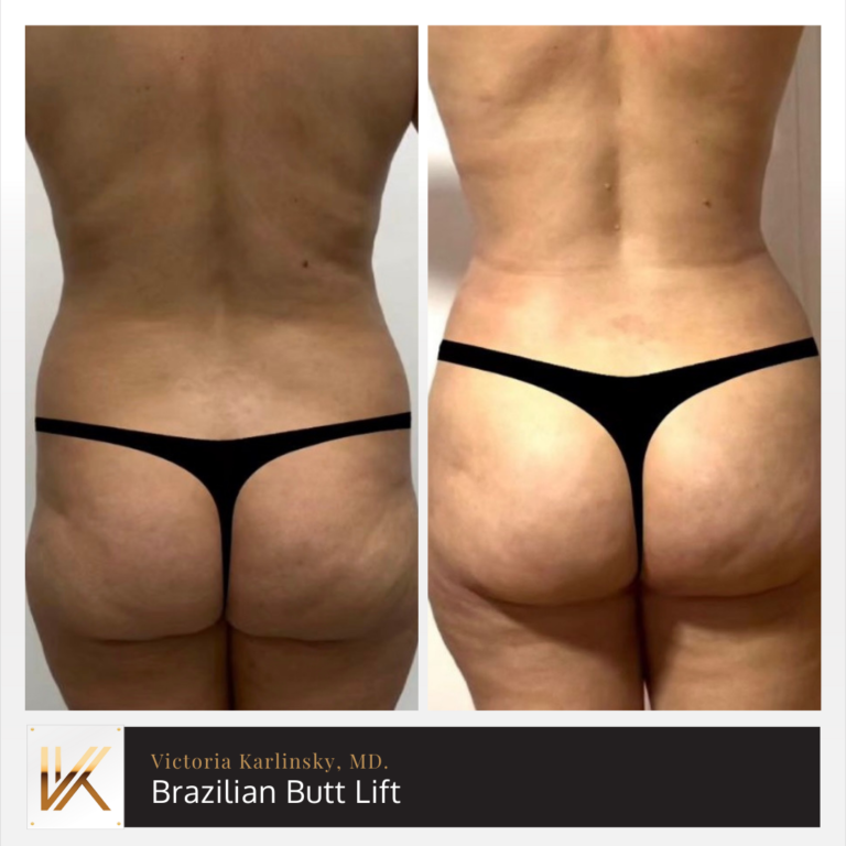 Alluring Plastic Surgery - Brazilian Butt Lift