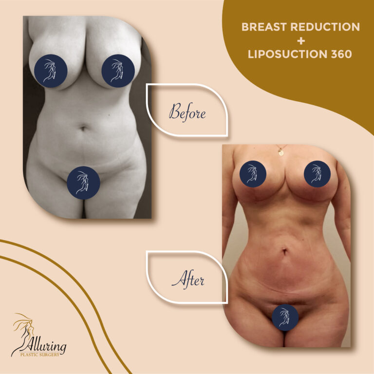 Alluring Plastic Surgery - Before & After - Breast Reduction