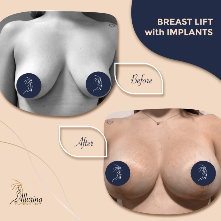 Alluring Plastic Surgery - Before & After - Breast Augmentation