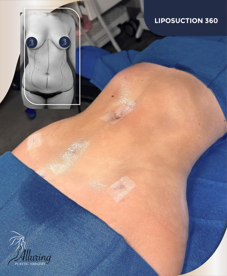 Alluring Plastic Surgery - Before & After - Tummy Tuck
