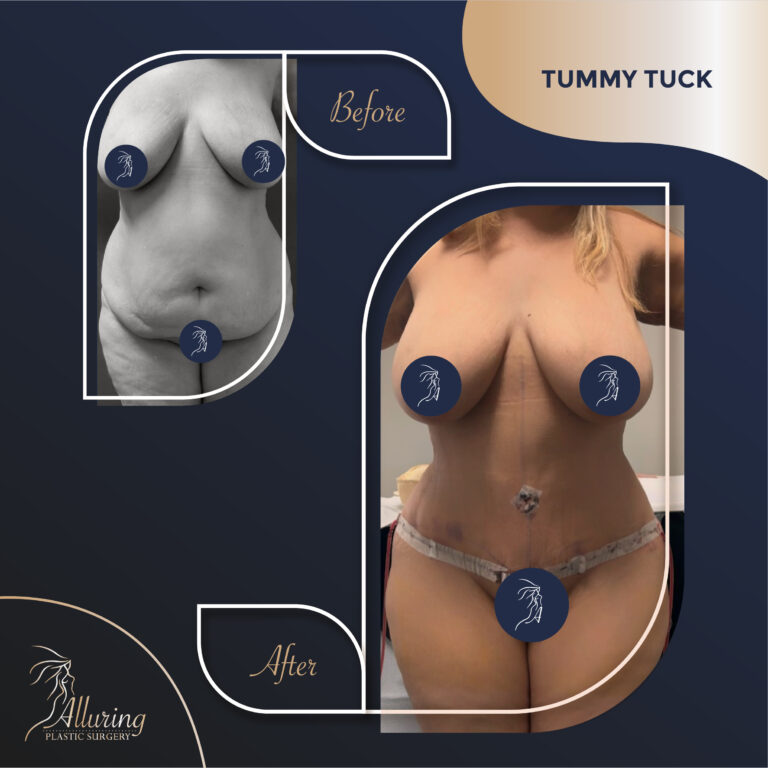 Alluring Plastic Surgery - Before & After - Tummy Tuck