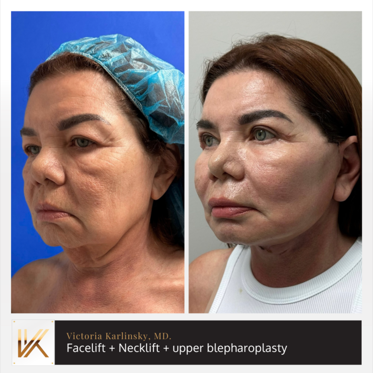 Alluring Plastic Surgery - Before & After - Face Lift