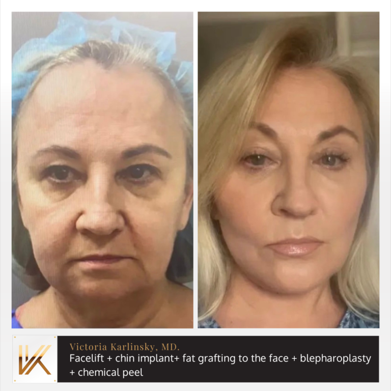 Alluring Plastic Surgery - Before & After - Face Lift
